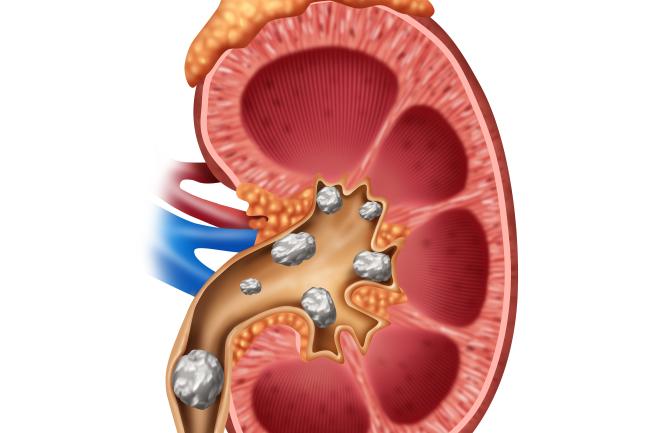 Ilustración de un riñón con cálculos renales en su interior.