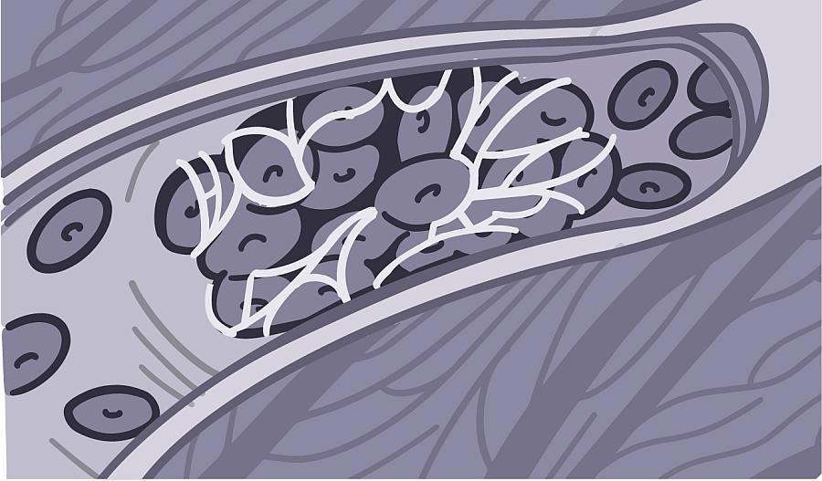 Ilustración de un coágulo de sangre en un vaso venoso